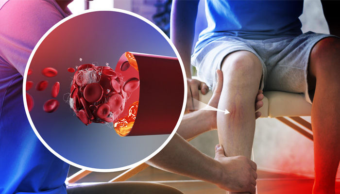 Warning: Your Veins Could Be Plotting Against You! Uncover the Hidden Dangers of Deep Vein Thrombosis