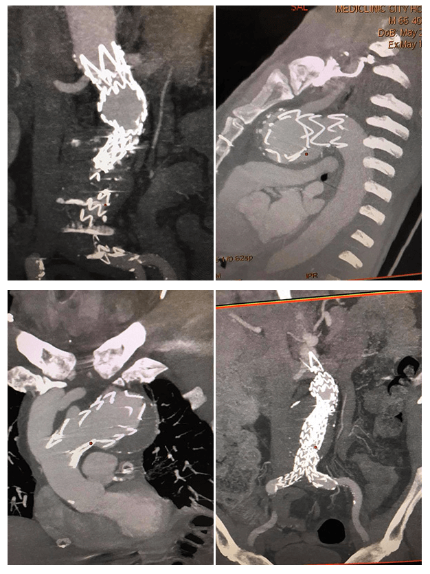 Symptomatic Aortic arch and infra-renal aortic aneurysm