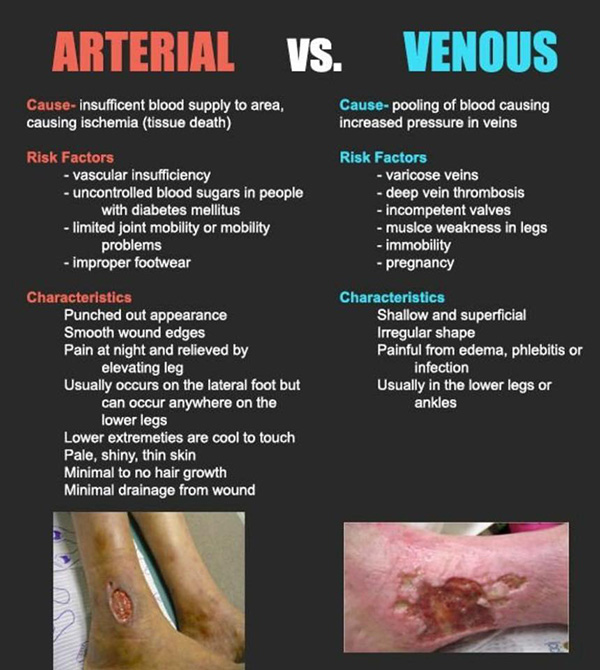 an image about the difference of arterial vs venous
